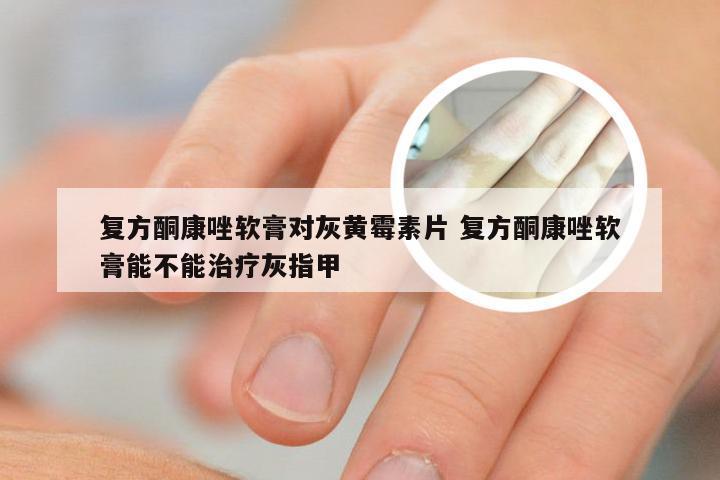 复方酮康唑软膏对灰黄霉素片 复方酮康唑软膏能不能治疗灰指甲