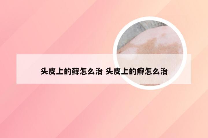 头皮上的藓怎么治 头皮上的癣怎么治
