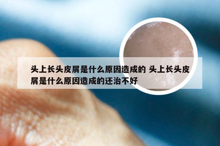 头上长头皮屑是什么原因造成的 头上长头皮屑是什么原因造成的还治不好