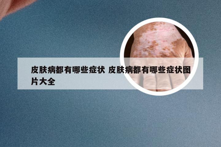 皮肤病都有哪些症状 皮肤病都有哪些症状图片大全