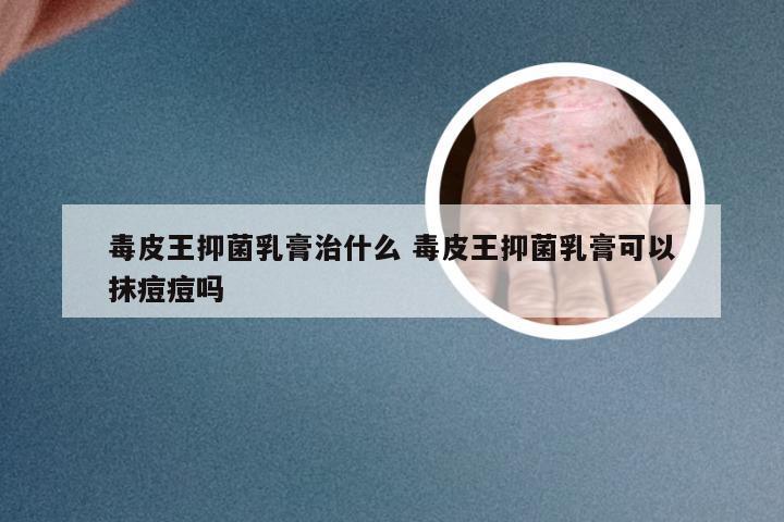 毒皮王抑菌乳膏治什么 毒皮王抑菌乳膏可以抹痘痘吗