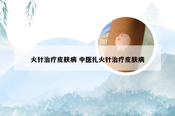 火针治疗皮肤病 中医扎火针治疗皮肤病