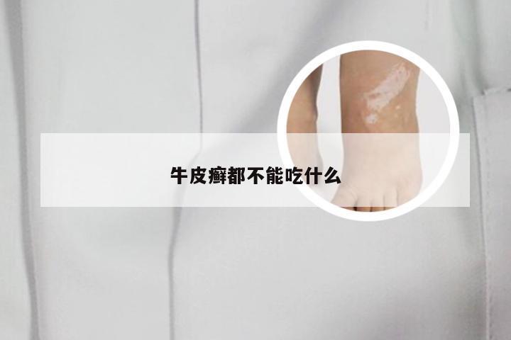 牛皮癣都不能吃什么