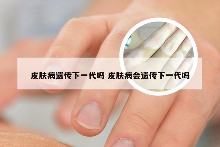 皮肤病遗传下一代吗 皮肤病会遗传下一代吗
