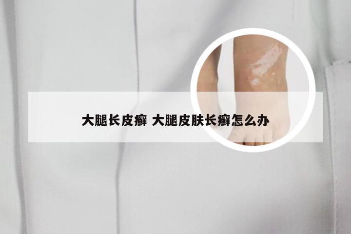 大腿长皮癣 大腿皮肤长癣怎么办