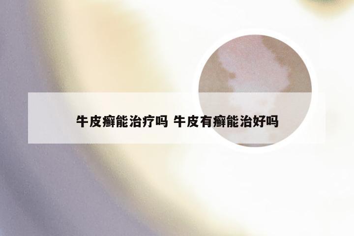 牛皮癣能治疗吗 牛皮有癣能治好吗