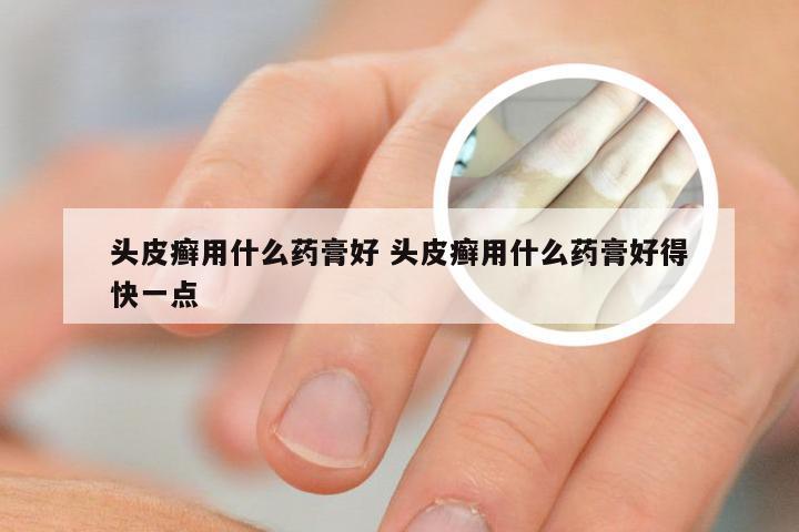 头皮癣用什么药膏好 头皮癣用什么药膏好得快一点