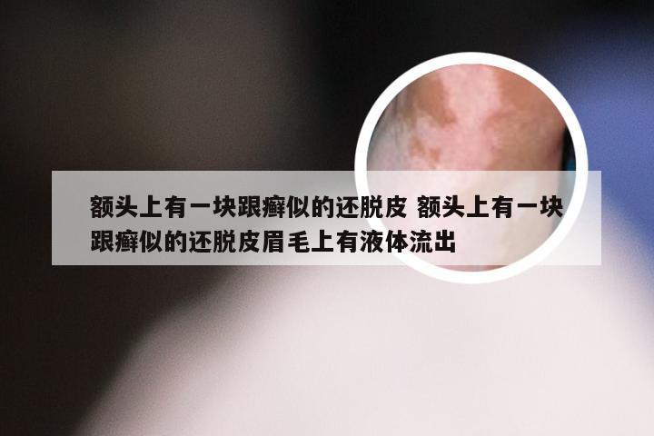 额头上有一块跟癣似的还脱皮 额头上有一块跟癣似的还脱皮眉毛上有液体流出