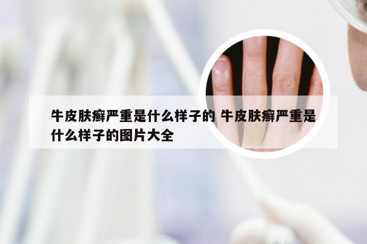 牛皮肤癣严重是什么样子的 牛皮肤癣严重是什么样子的图片大全