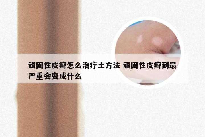顽固性皮癣怎么治疗土方法 顽固性皮癣到最严重会变成什么