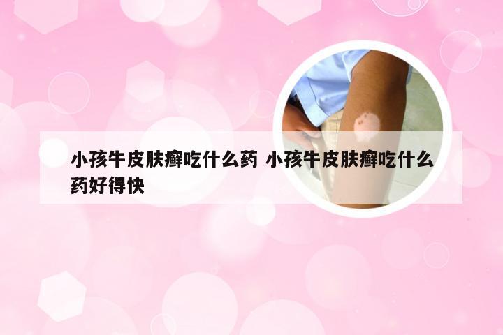小孩牛皮肤癣吃什么药 小孩牛皮肤癣吃什么药好得快
