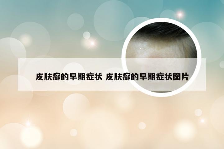 皮肤癣的早期症状 皮肤癣的早期症状图片