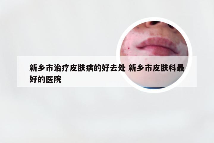 新乡市治疗皮肤病的好去处 新乡市皮肤科最好的医院