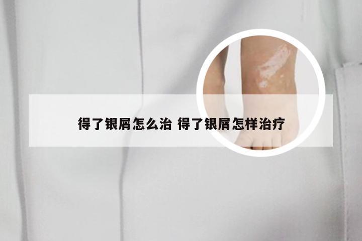 得了银屑怎么治 得了银屑怎样治疗