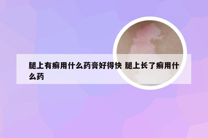 腿上有癣用什么药膏好得快 腿上长了癣用什么药