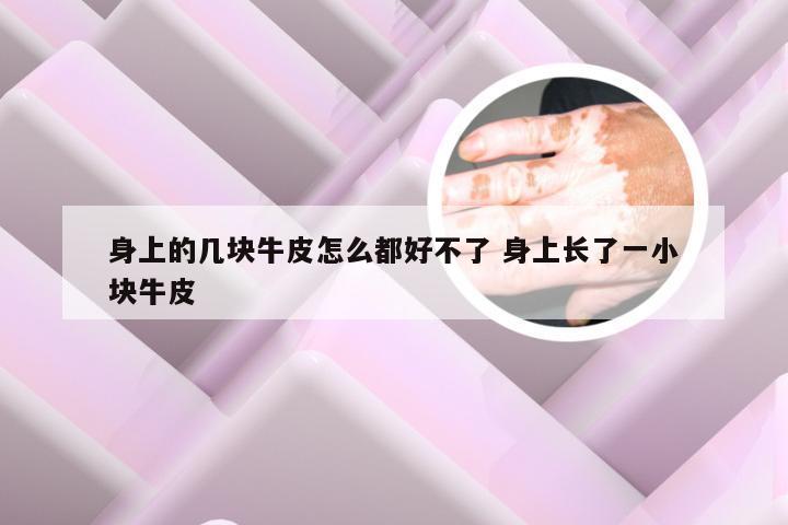 身上的几块牛皮怎么都好不了 身上长了一小块牛皮