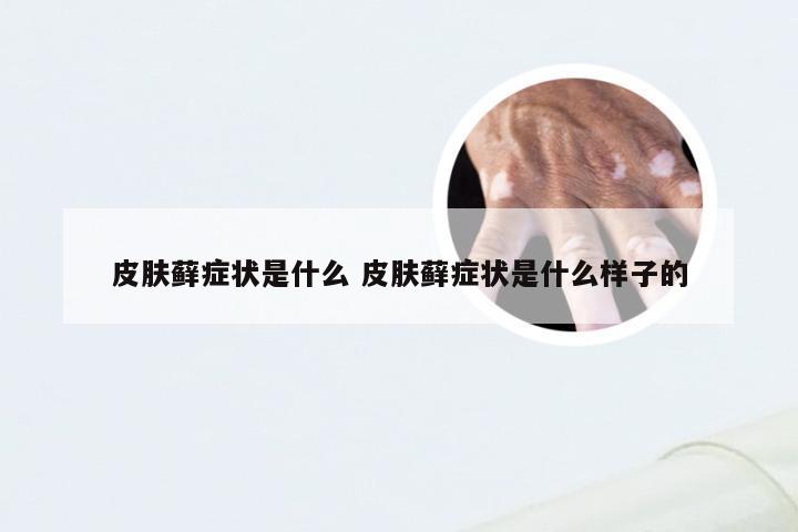 皮肤藓症状是什么 皮肤藓症状是什么样子的