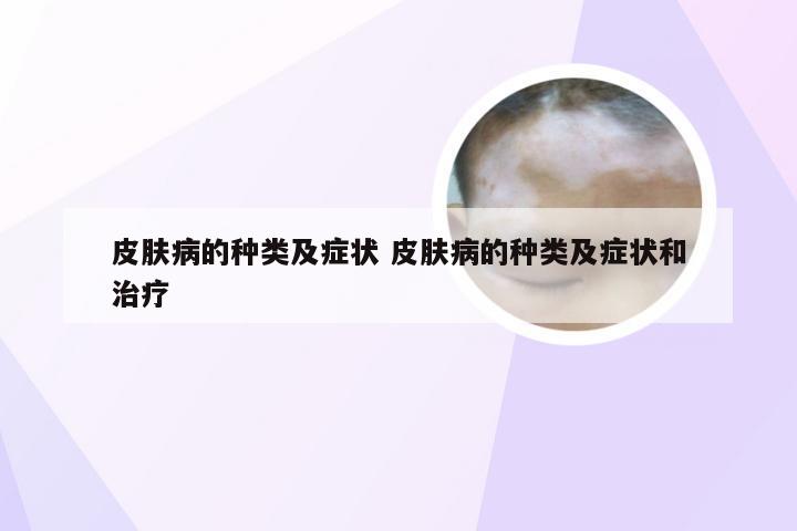 皮肤病的种类及症状 皮肤病的种类及症状和治疗