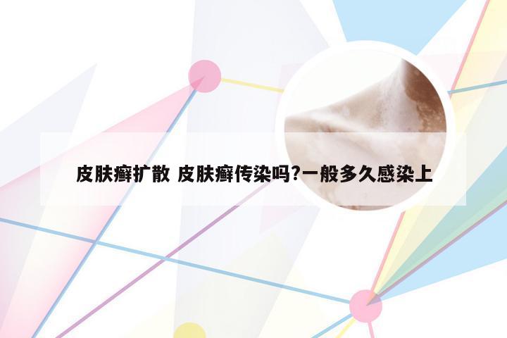 皮肤癣扩散 皮肤癣传染吗?一般多久感染上