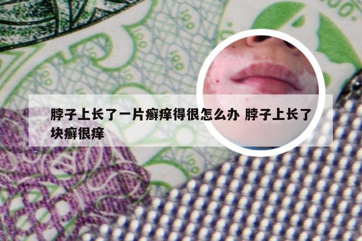 脖子上长了一片癣痒得很怎么办 脖子上长了块癣很痒