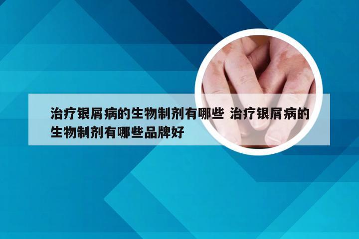 治疗银屑病的生物制剂有哪些 治疗银屑病的生物制剂有哪些品牌好