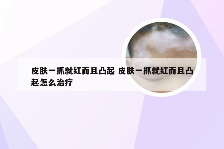 皮肤一抓就红而且凸起 皮肤一抓就红而且凸起怎么治疗