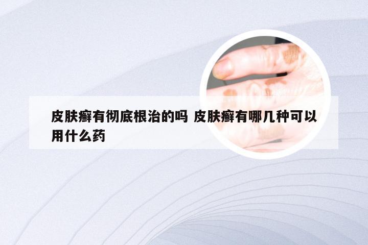 皮肤癣有彻底根治的吗 皮肤癣有哪几种可以用什么药