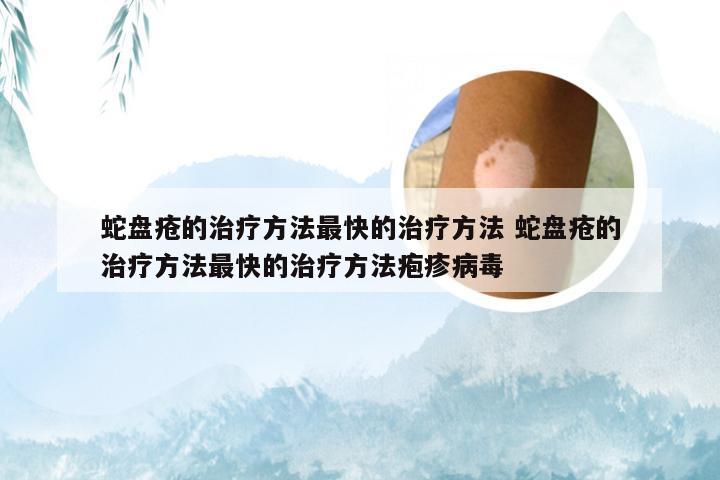 蛇盘疮的治疗方法最快的治疗方法 蛇盘疮的治疗方法最快的治疗方法疱疹病毒