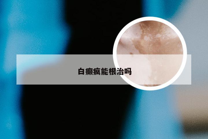 白癫疯能根治吗