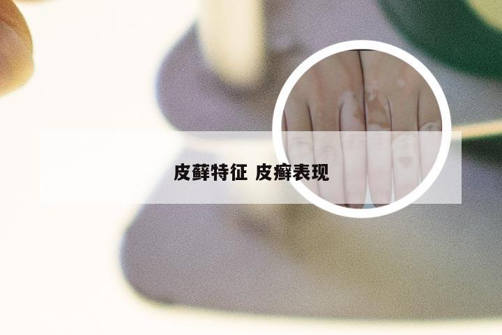 皮藓特征 皮癣表现