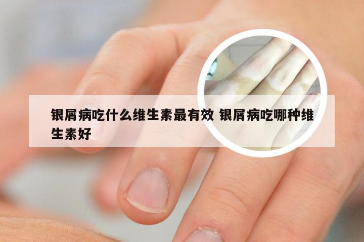 银屑病吃什么维生素最有效 银屑病吃哪种维生素好