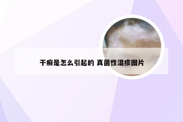 干癣是怎么引起的 真菌性湿疹图片