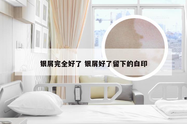 银屑完全好了 银屑好了留下的白印