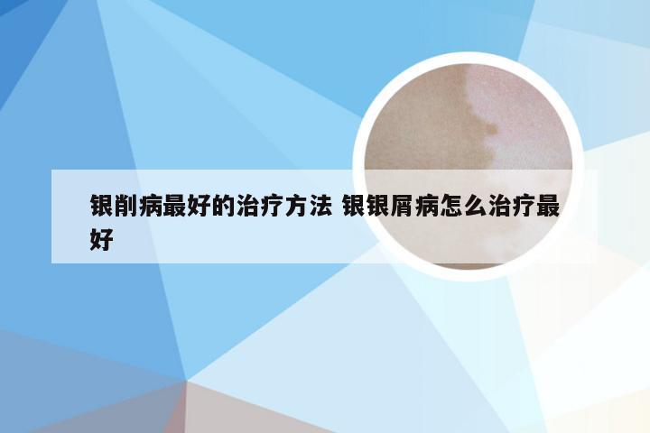 银削病最好的治疗方法 银银屑病怎么治疗最好