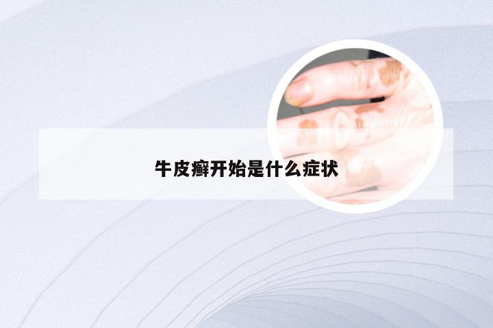 牛皮癣开始是什么症状