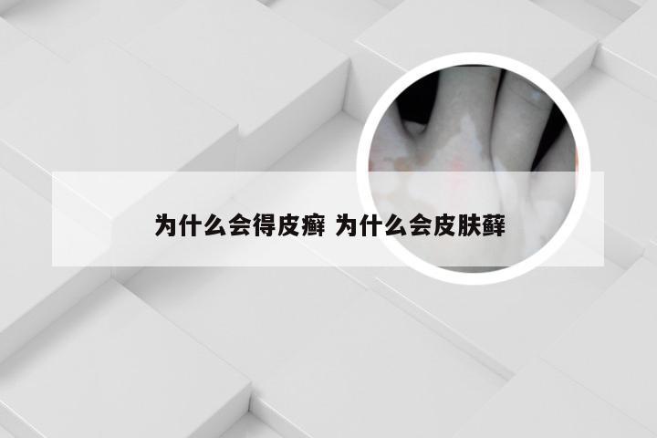 为什么会得皮癣 为什么会皮肤藓