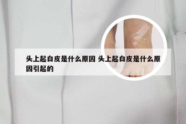 头上起白皮是什么原因 头上起白皮是什么原因引起的