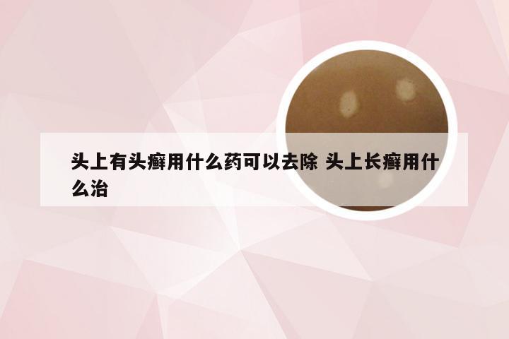 头上有头癣用什么药可以去除 头上长癣用什么治