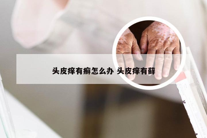 头皮痒有癣怎么办 头皮痒有藓