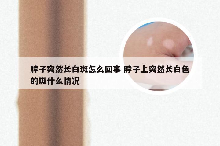 脖子突然长白斑怎么回事 脖子上突然长白色的斑什么情况