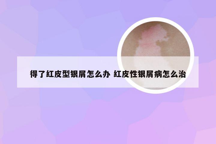 得了红皮型银屑怎么办 红皮性银屑病怎么治