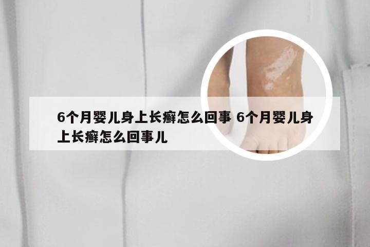 6个月婴儿身上长癣怎么回事 6个月婴儿身上长癣怎么回事儿