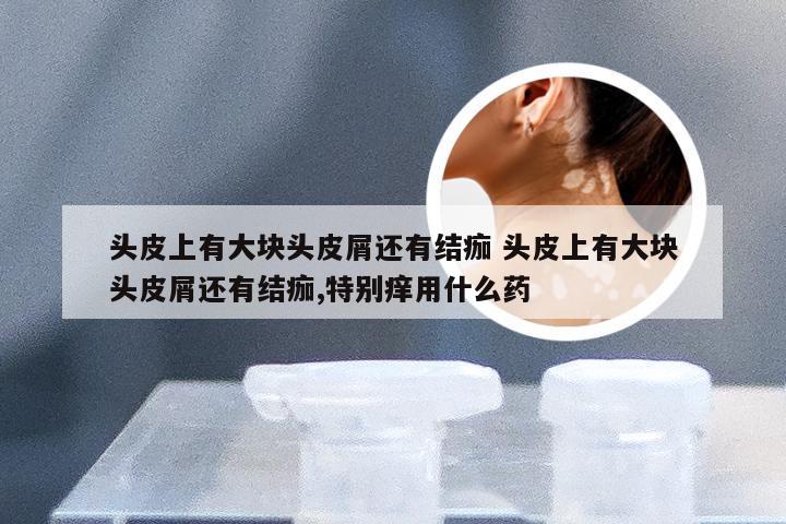 头皮上有大块头皮屑还有结痂 头皮上有大块头皮屑还有结痂,特别痒用什么药