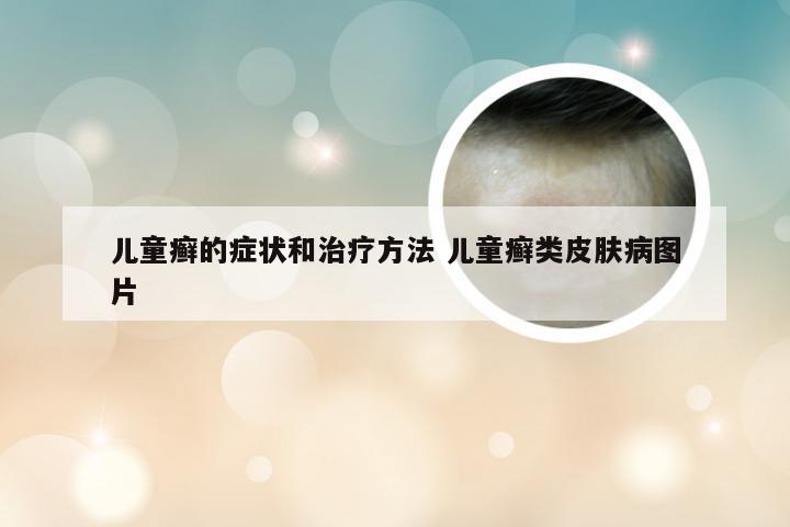 儿童癣的症状和治疗方法 儿童癣类皮肤病图片