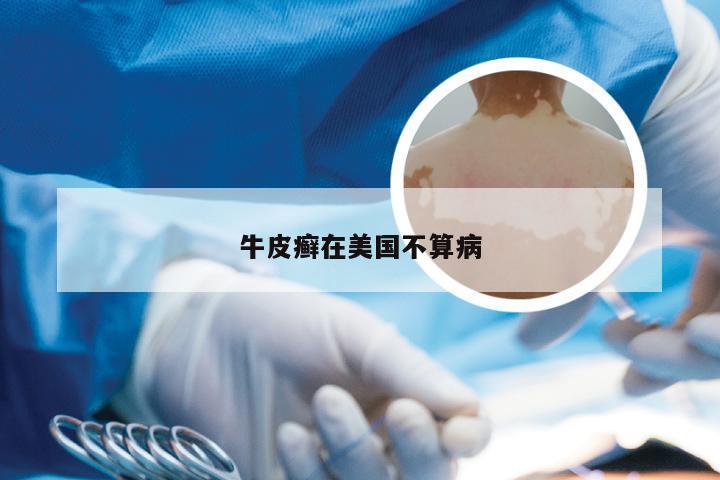 牛皮癣在美国不算病