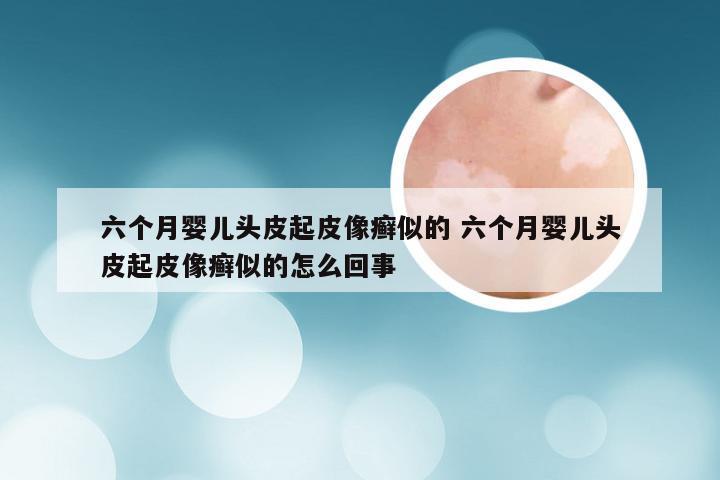 六个月婴儿头皮起皮像癣似的 六个月婴儿头皮起皮像癣似的怎么回事