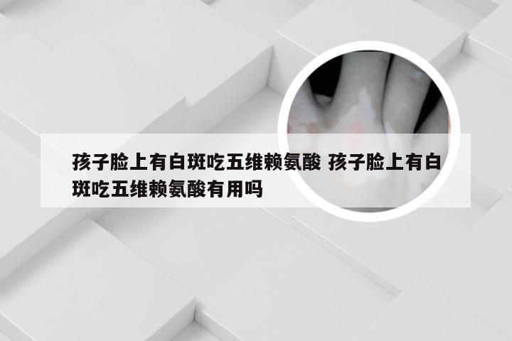 孩子脸上有白斑吃五维赖氨酸 孩子脸上有白斑吃五维赖氨酸有用吗