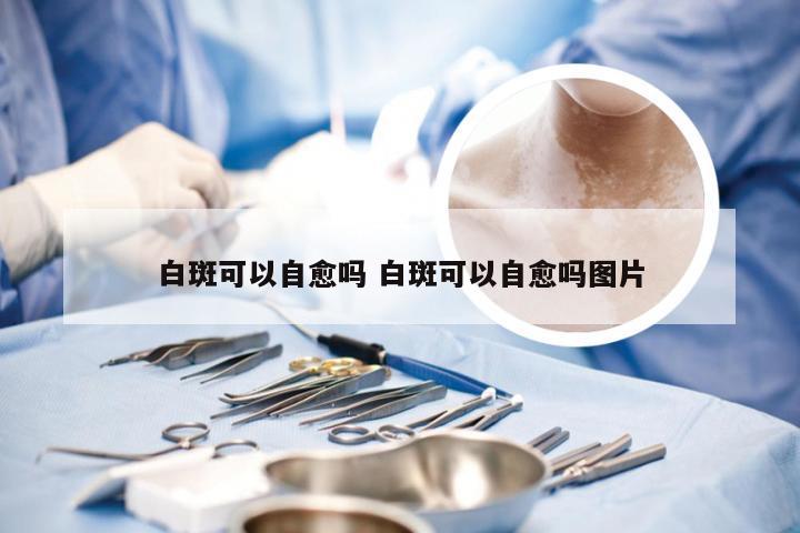 白斑可以自愈吗 白斑可以自愈吗图片