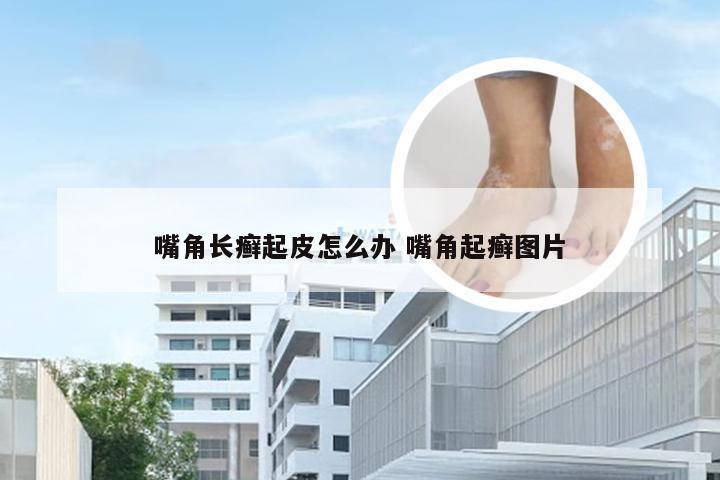 嘴角长癣起皮怎么办 嘴角起癣图片