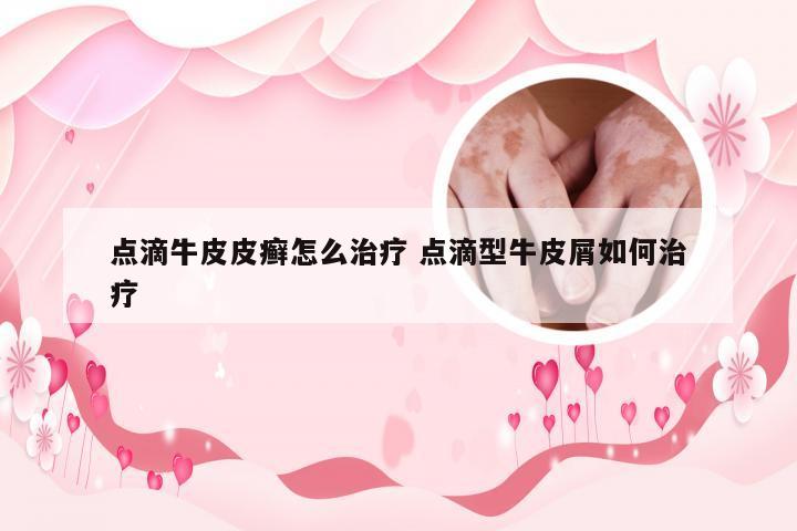 点滴牛皮皮癣怎么治疗 点滴型牛皮屑如何治疗